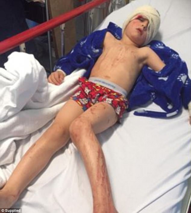 1498541992820058431.jpg 浴室玻璃门忽然爆裂 4岁男孩全身被划伤